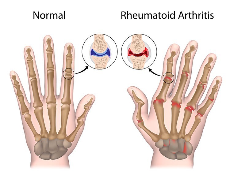 Rheumatoid Arthritis Pain Relief In Bellingham , WA - Bellingham Acupuncture Clinic